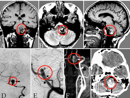 咽不下、說不清、臉歪，較大動脈瘤壓迫腦干，切除并血管搭橋術(shù)后如常