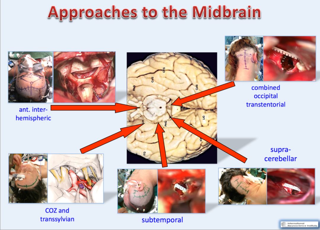 較大腦干海綿狀血管瘤手術(shù)入路