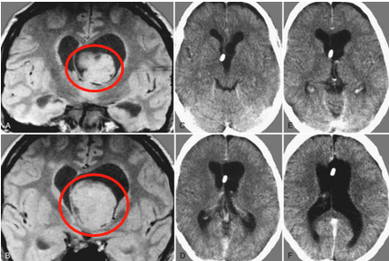 不同年齡、位置、階段的室管膜瘤，國(guó)際治療指南都怎么說(shuō)的？