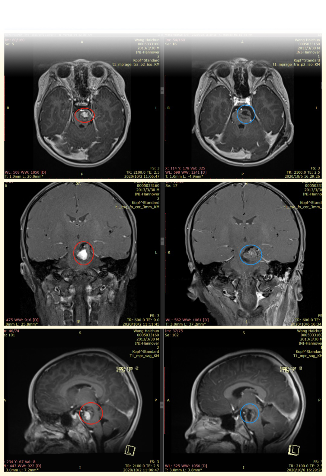 腦干海綿狀血管瘤術前術后對比