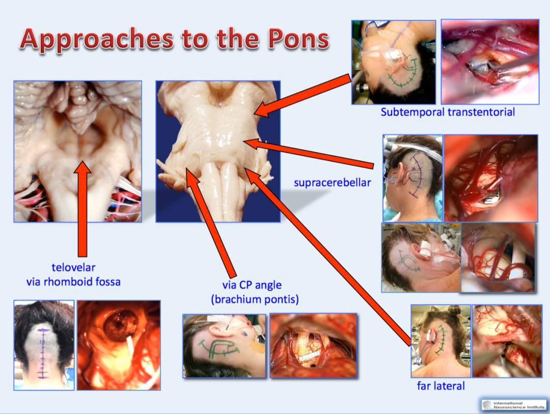 腦干海綿狀血管瘤手術入路