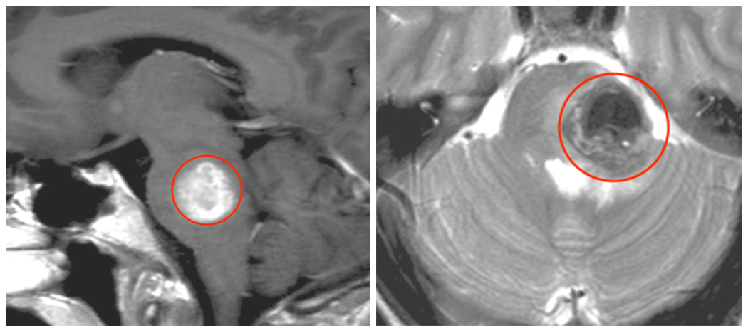 術(shù)中神經(jīng)電生理聯(lián)合導(dǎo)航手術(shù)全切腦干海綿狀血管瘤，從此不怕復(fù)發(fā)、腦干出血！