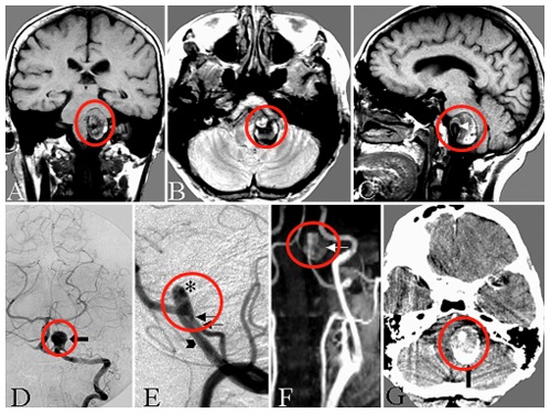 破裂及未破裂動脈瘤的手術(shù)入路及策略分析