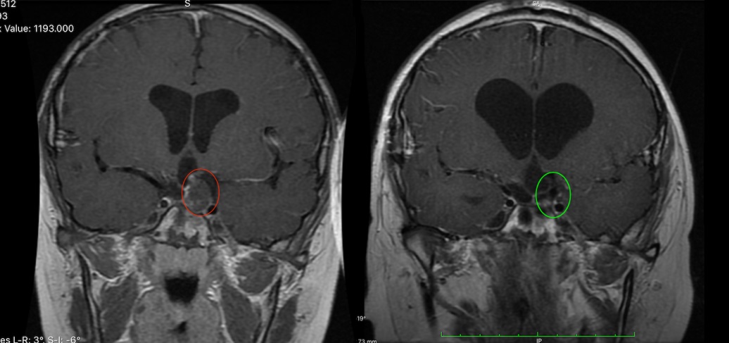 陽光男孩與顱咽管瘤的16年抗?fàn)幨?></a>
                    </div>
                    <div   id=