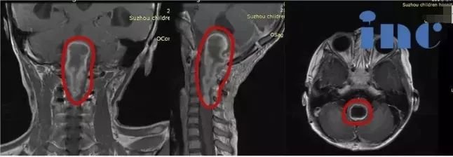 腦干、脊髓、視神經等疑難兒童腦瘤真的無法手術嗎？INC復雜手術成功案例集錦