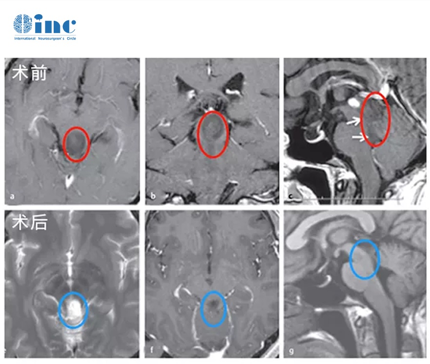 腦干乳頭狀膠質(zhì)神經(jīng)元腫瘤PGNT