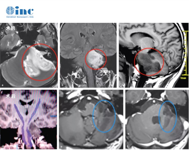 腦干膠質(zhì)母細(xì)胞瘤