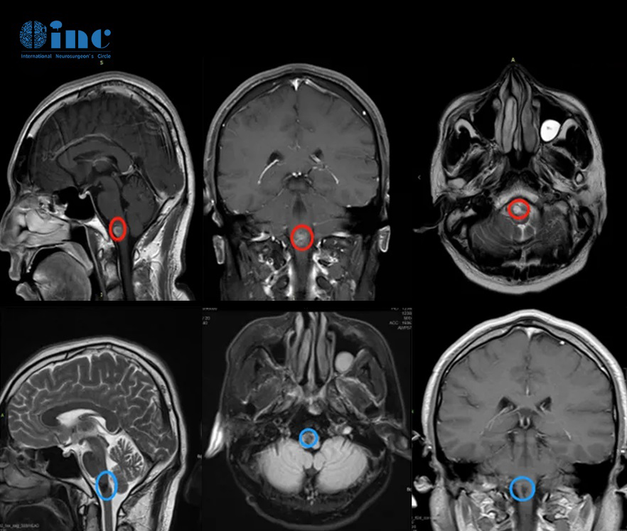 腦干海綿狀血管瘤