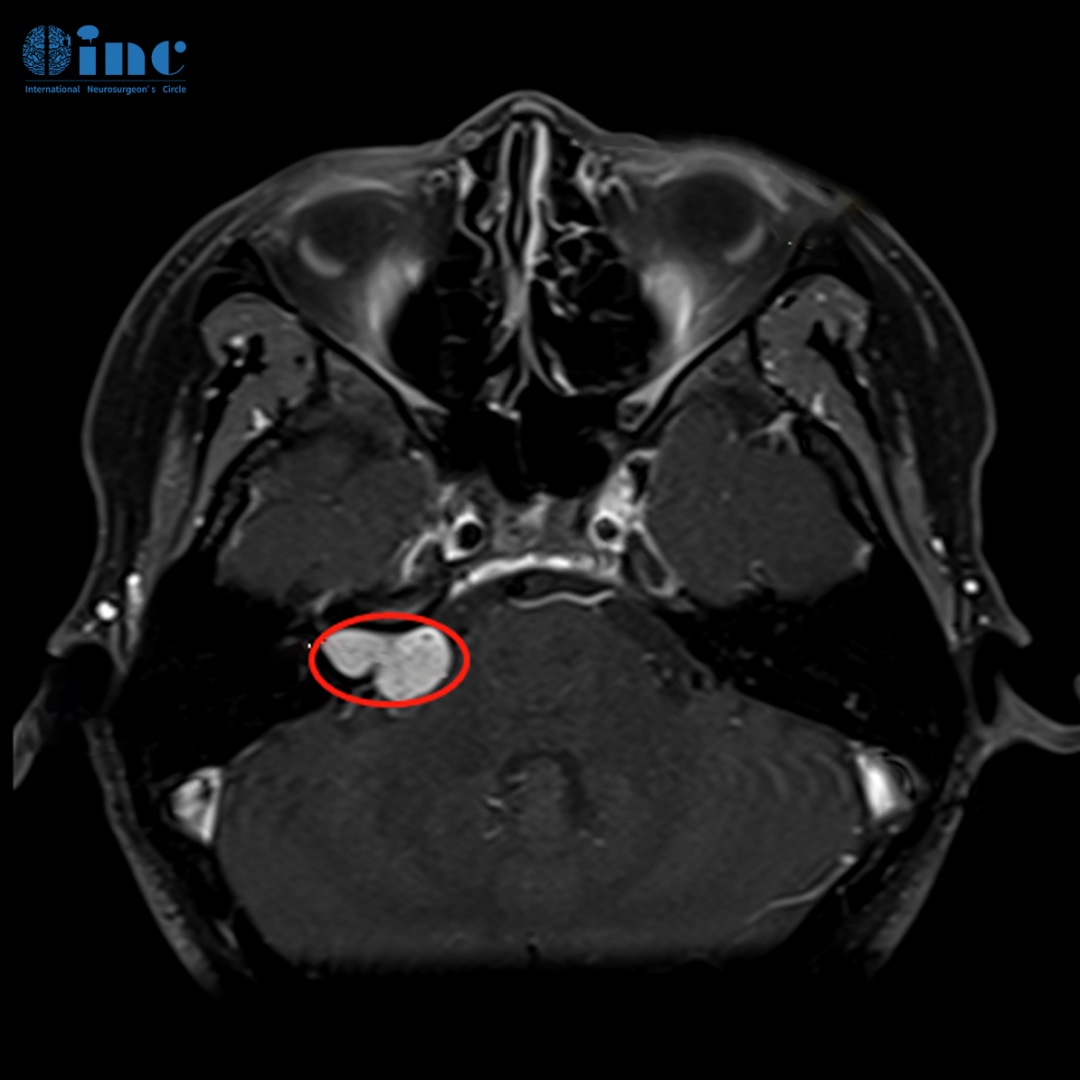 聽神經瘤MR