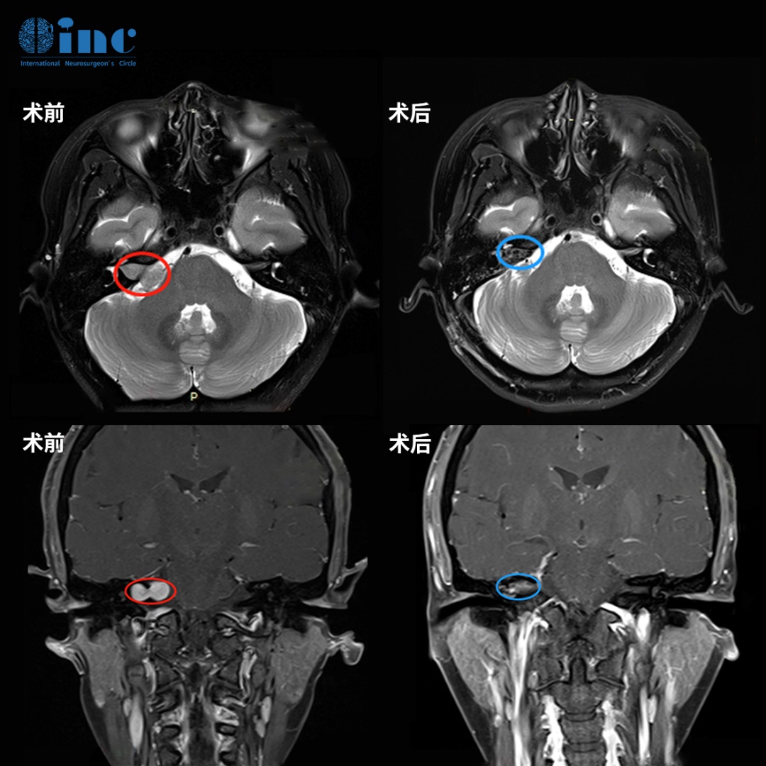 內(nèi)聽道型聽神經(jīng)瘤翻倍長，反復(fù)突發(fā)耳聾，如何做到根治并保全聽力、不面癱？