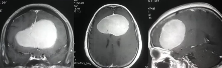 腦瘤從櫻桃長(zhǎng)成了蘋果大、壓扁大腦！較大腦膜瘤還能全切且不傷大腦嗎？