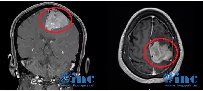 腦膜瘤術(shù)前