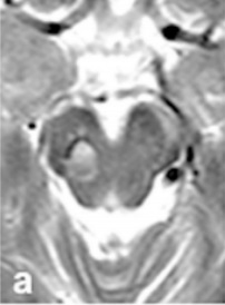 中腦海綿狀血管瘤出血