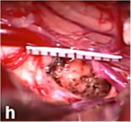 中腦海綿狀血管瘤