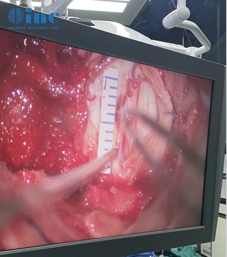 術(shù)中測(cè)量腫瘤大小與影像圖片中的大小進(jìn)行對(duì)比，確保切除干凈