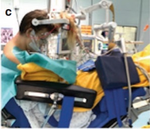 松果體區(qū)海綿狀血管瘤