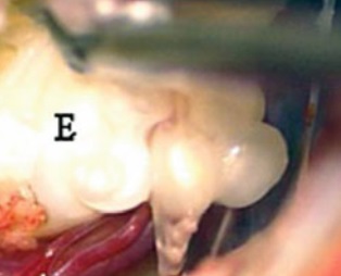 不面癱、不癱瘓，“珍珠”般的CPA橋小腦角區(qū)膽脂瘤如何一步步完整切除？
