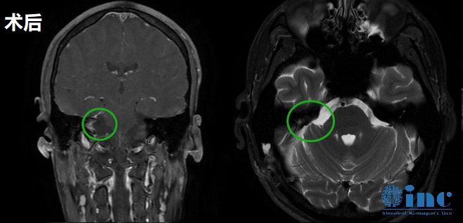 聽神經(jīng)瘤術(shù)后影像