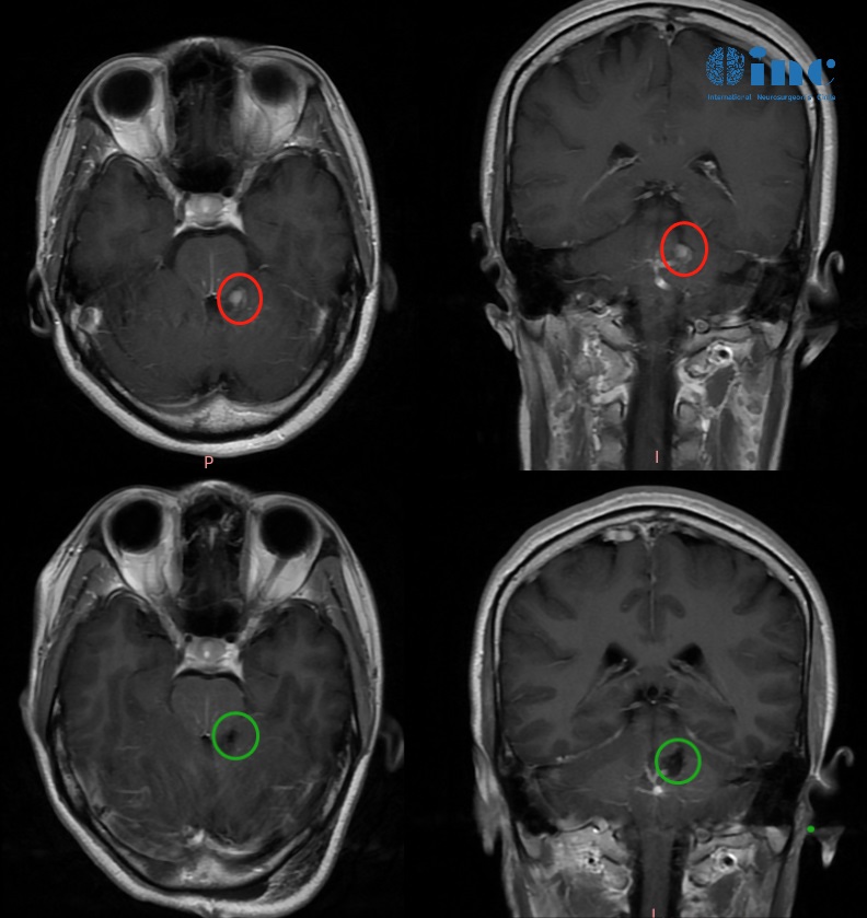 國際神外教授來華示范手術(shù)：順利全切“手術(shù)禁區(qū)”腦干海綿狀血管瘤！