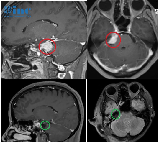 腦膜瘤難切干凈、容易復(fù)發(fā)？這些疑難位置腦膜瘤看巴教授如何成功攻克！