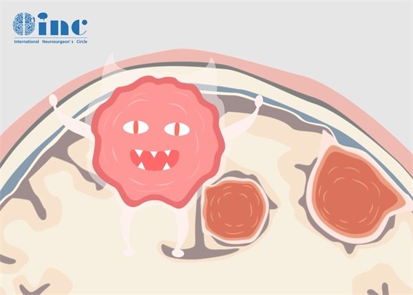 右側(cè)頂葉腦膜瘤鈣化嚴(yán)重嗎