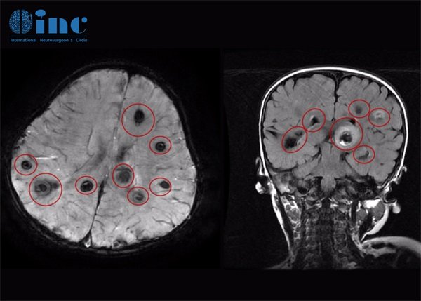 左頂葉海綿狀血管瘤疼痛怎么緩解