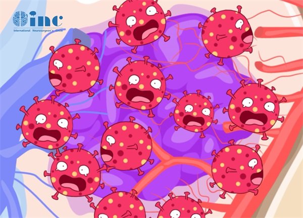 右側(cè)頂葉腦膜瘤鈣化可能性大嗎