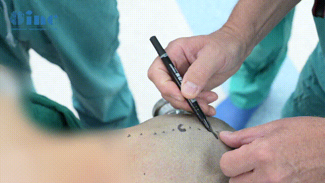 20歲腦干中腦血管畸形案例：面癱、話說不清、嗆咳、走路不穩(wěn)……巴教授腦干術后1天全部緩解