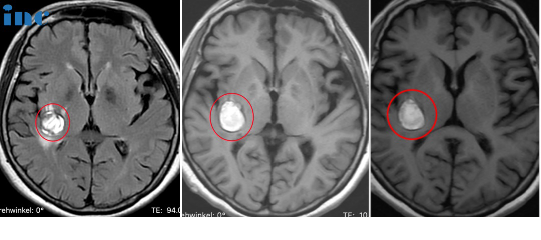 68歲女性柯女士——基底節(jié)海綿狀血管瘤