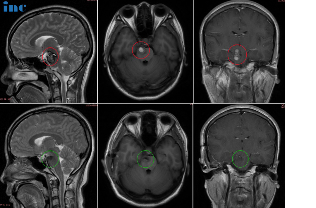 30歲女士萱萱——腦干-中腦及橋腦海綿狀血管瘤