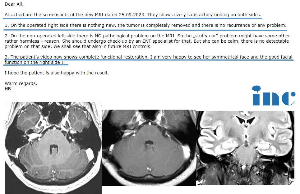 較大聽(tīng)神經(jīng)瘤術(shù)后2年隨訪，沒(méi)有復(fù)發(fā)、無(wú)面癱、無(wú)后遺癥！