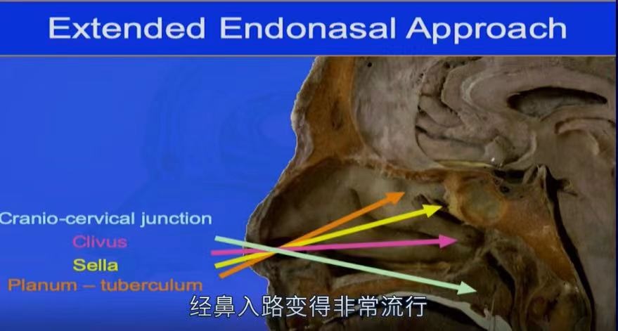 Froelich教授演講截圖：經(jīng)鼻內(nèi)鏡示意圖
