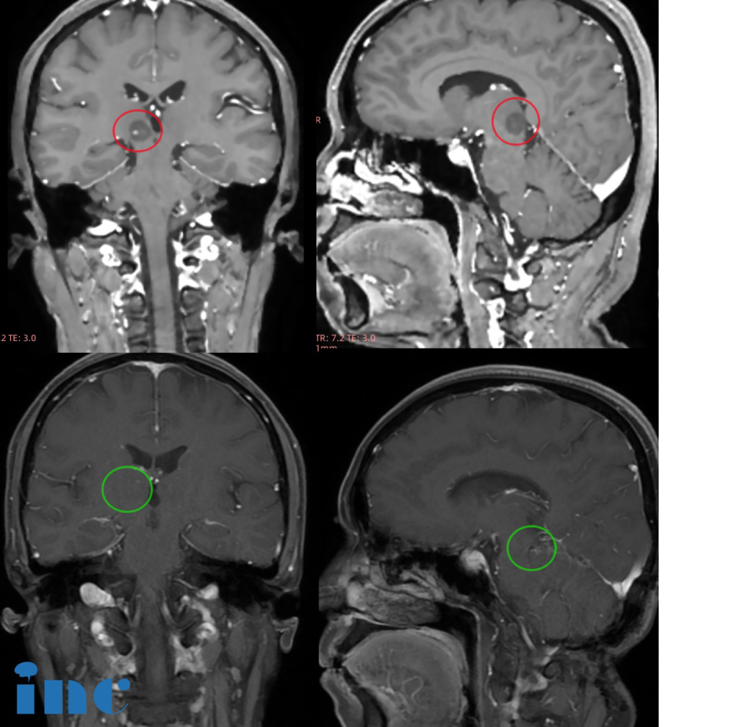 高難度丘腦膠質(zhì)瘤術(shù)后近1年交流，沒有復(fù)發(fā)、正常工作生活！