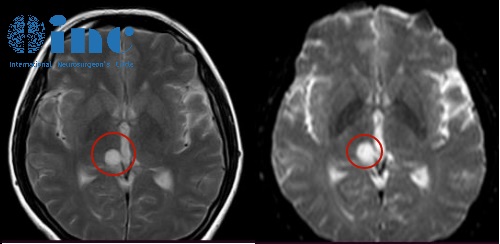 高難度丘腦膠質(zhì)瘤術(shù)后患者自述——影像圖