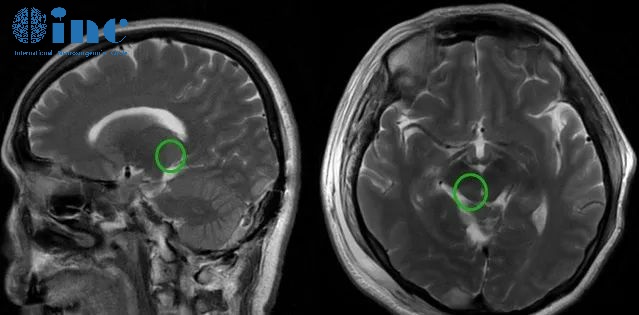 高難度丘腦膠質(zhì)瘤術(shù)后患者自述——術(shù)后影像