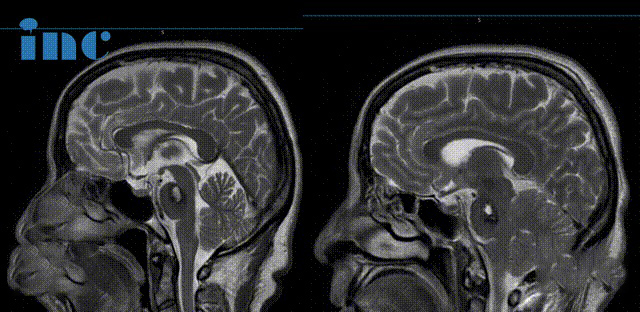 術(shù)前及術(shù)后1天影像對比
