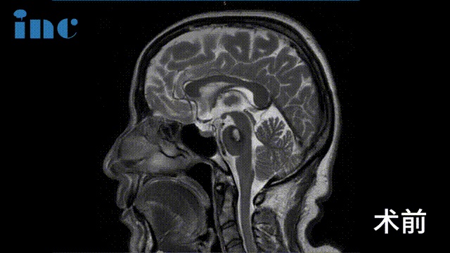腦干海綿狀血管瘤影像