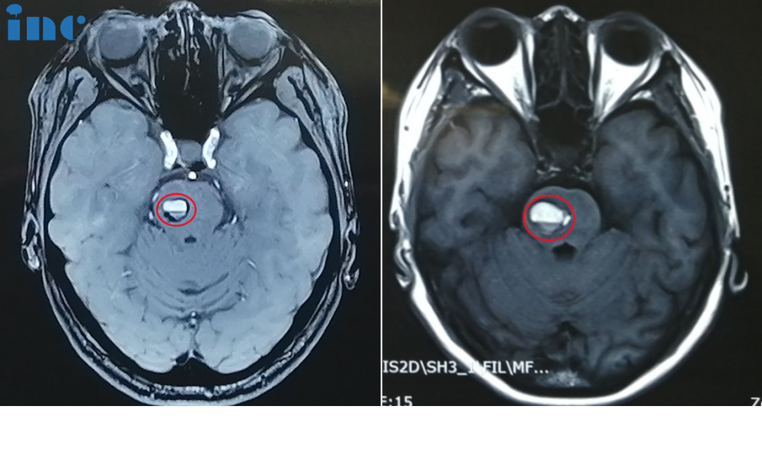 腦干海綿狀血管瘤影像
