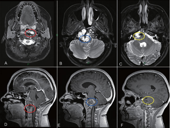 37歲女性復(fù)發(fā)難治性脊索瘤5年4次手術(shù)