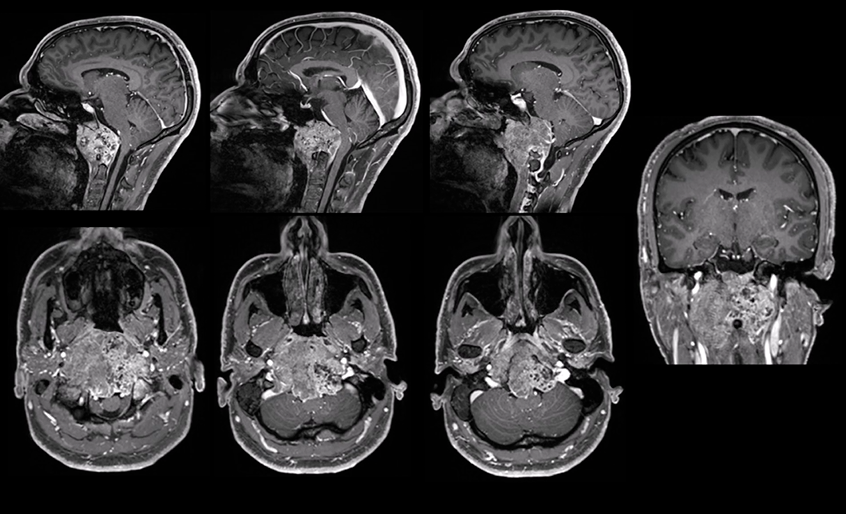 顯微鏡+神經(jīng)內(nèi)鏡雙鏡聯(lián)合全切巨型脊索瘤