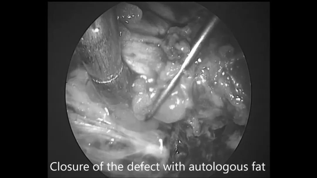 使用自體脂肪填充瘤腔及關(guān)顱