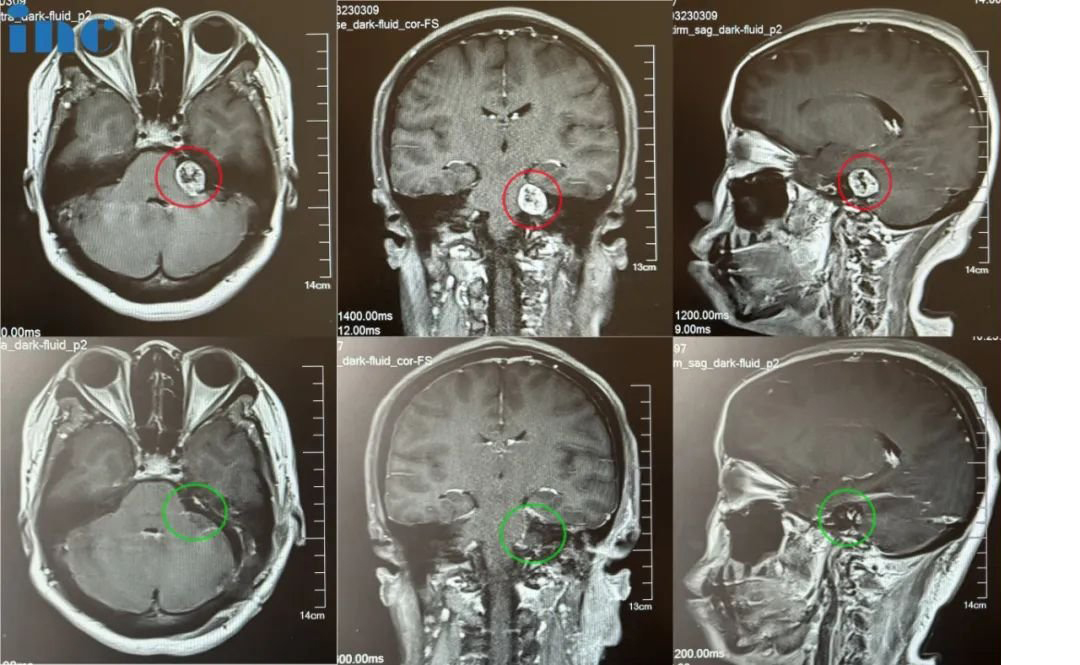 北京天壇醫(yī)院手術(shù)紀(jì)實(shí)——INC巴教授成功為一名聽(tīng)神經(jīng)瘤患者順利全切手術(shù)