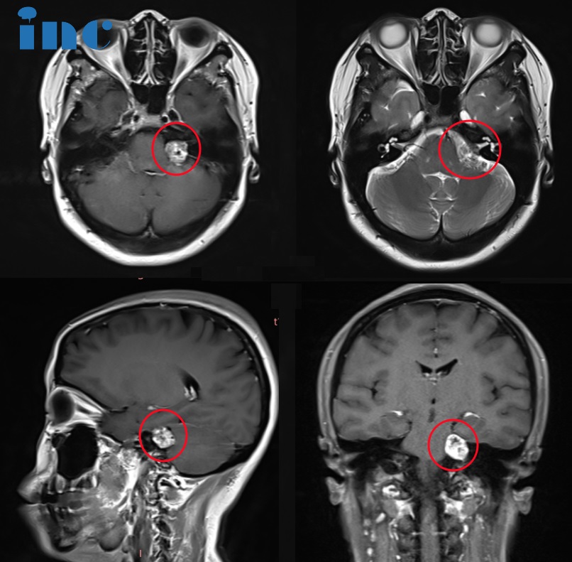 聽神經(jīng)瘤真的沒法順利全切嗎