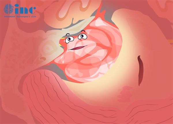 聽神經(jīng)瘤手術(shù)要開顱還是微創(chuàng)