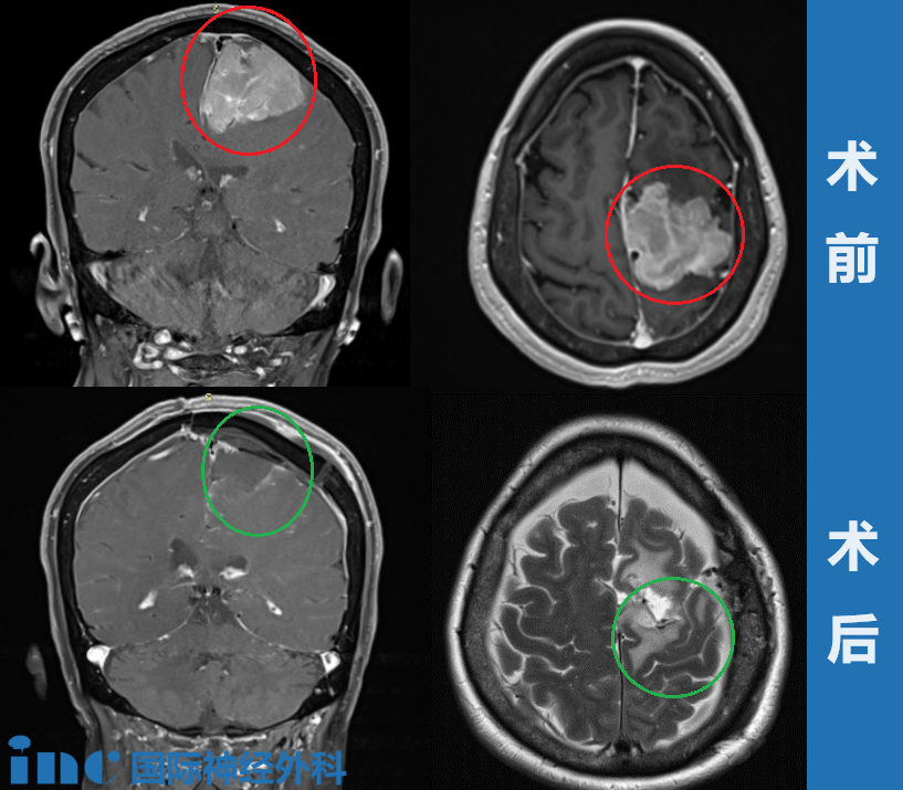 大腦鐮旁較大腦膜瘤——術(shù)前術(shù)后