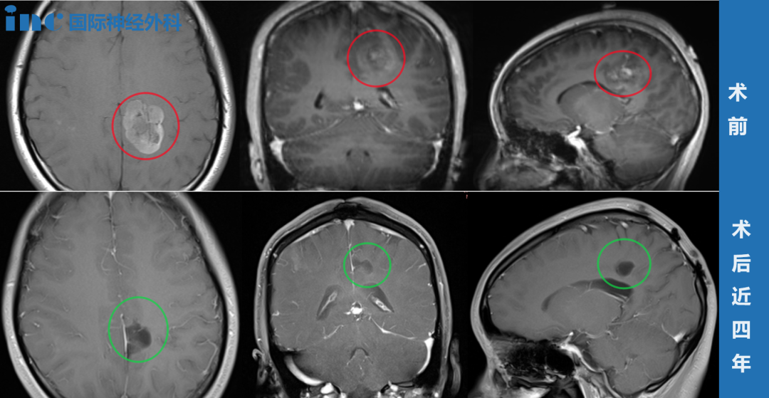 反復(fù)癲癇發(fā)作竟是膠質(zhì)瘤惹的禍，全切手術(shù)4年后沒(méi)有復(fù)發(fā)、無(wú)癲癇再發(fā)