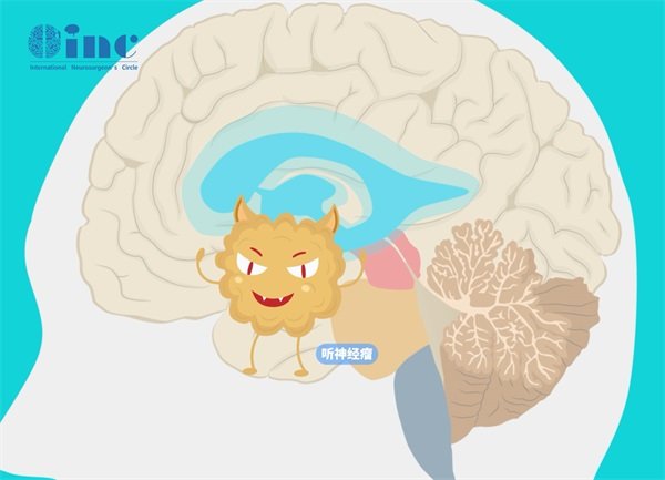 聽神經(jīng)瘤微創(chuàng)手術(shù)和開顱是一樣嗎