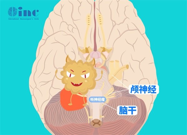 聽神經瘤切除術手術時間多長？切除后聽力會恢復嗎？