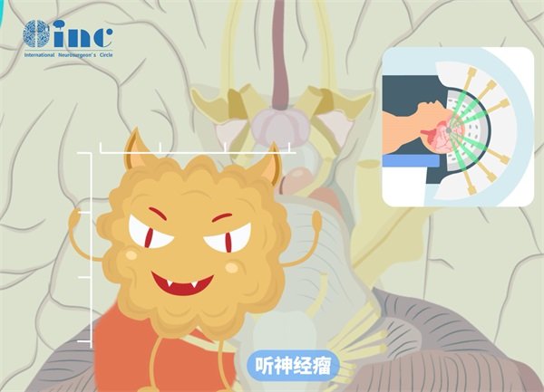 聽神經瘤切除術手術時間要多久？切除后耳鳴會消失嗎？