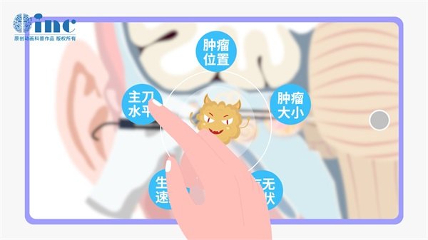 聽神經(jīng)瘤開顱手術(shù)壽命有多長